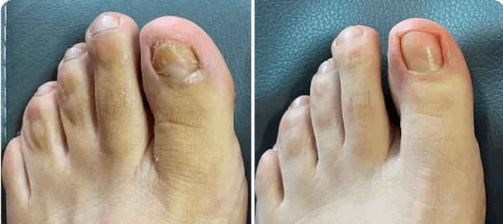 What is Orivelle Nail Fungus Pen – Orivele