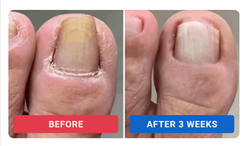 Orivelle Nail Fungus Pen review by Dan R. – Orivele