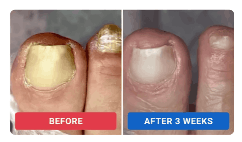 Orivelle Nail Fungus Pen review by Elena S. – Orivele