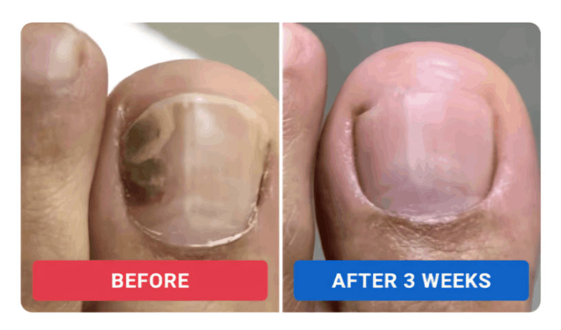 Orivelle Nail Fungus Pen review by Rachel M. – Orivele