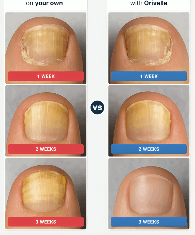 Orivelle Nail Fungus Pen before and after – Orivele